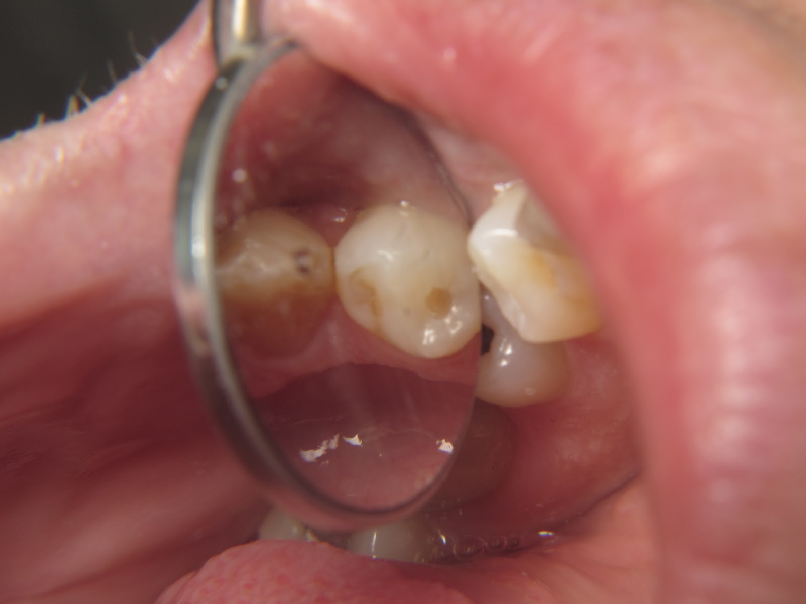 DENTALOLOGY Oh how cute, two little silver fillings