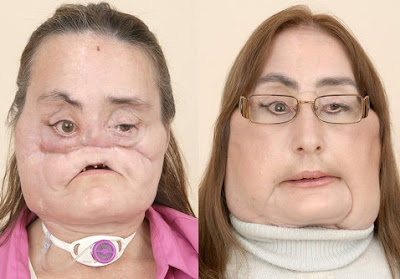 Connie Culp First Face Transplant