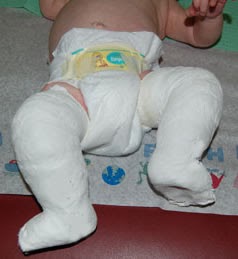 Club Foot: Treatment Options For Your Baby