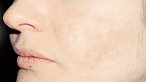 [microdermabrasion_acne_scar_before_1.bmp]