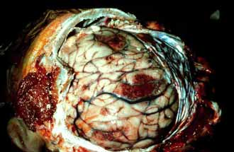 [askaridiash+egkefaloy.jpg]