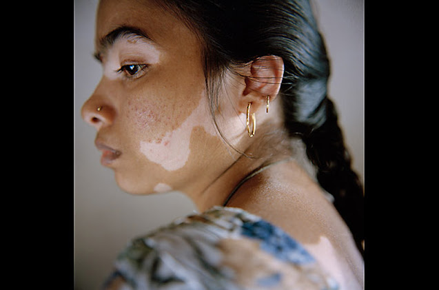 World Vitiligo Day - Ημέρα Λεύκης