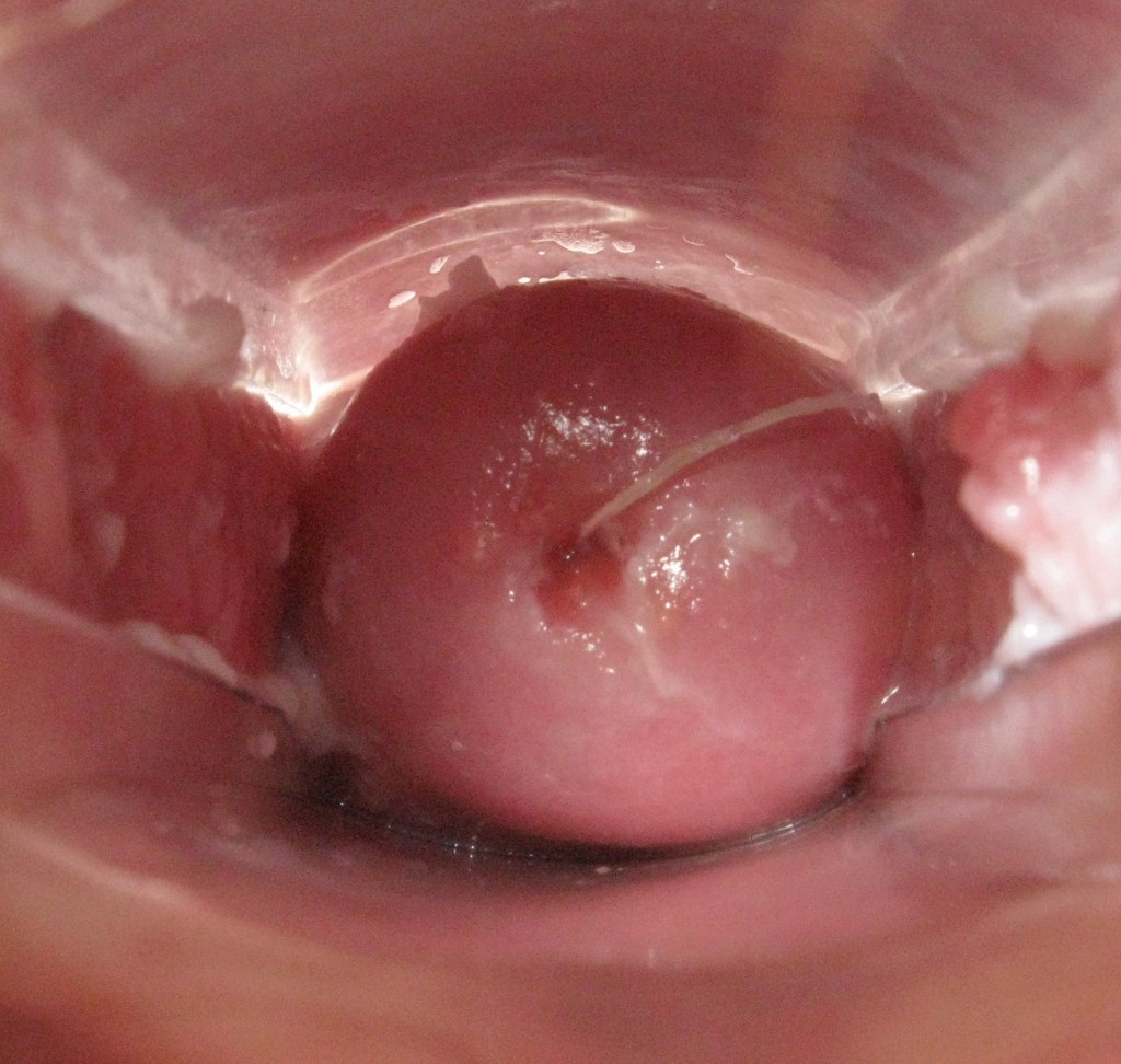 Cervix pics--tdonapos