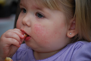 sulfa rashes allergy antibiotic spots gone thought morning monday were her so