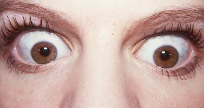 Oscar fish eyes bulging