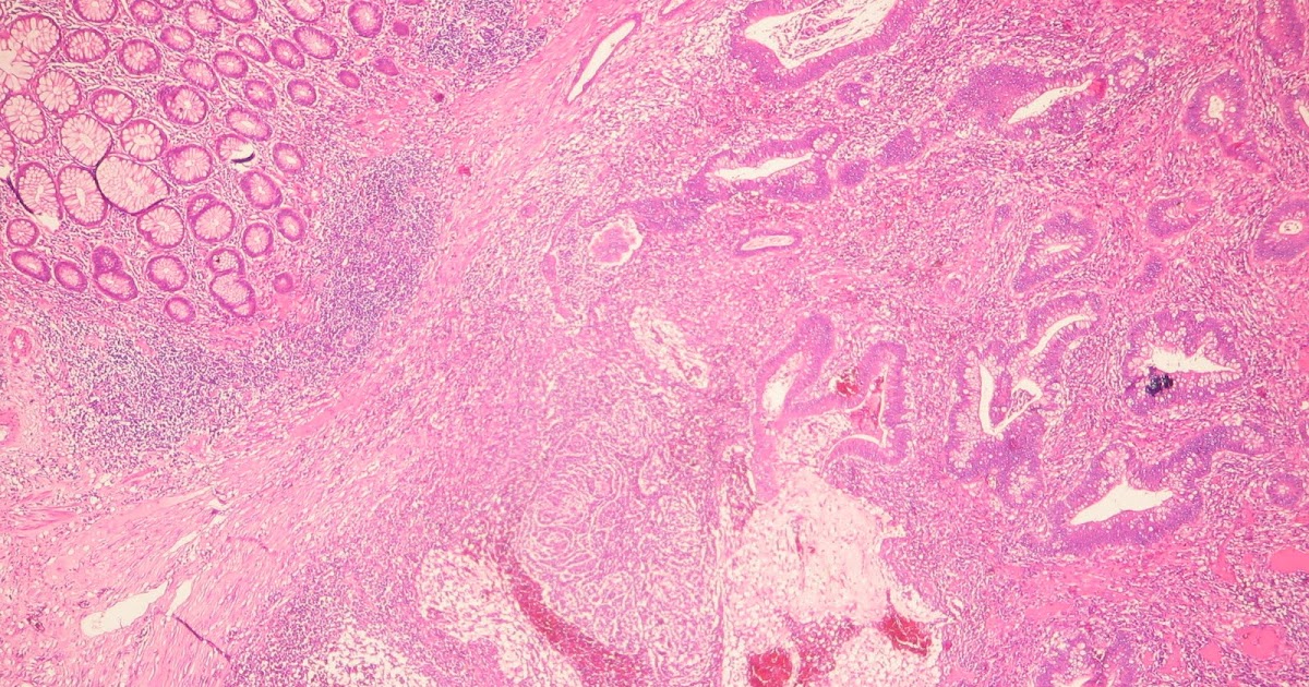 Forum Cu Persoane Care Au Facut Polipectomie The Colonoscopy Clinic: Polip colonic pediculat gigant. Polipectomie cu