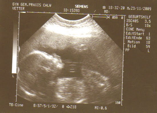 Renni Räumt Den Magen Auf Björn Vetter: Rennie räumt den Magen auf