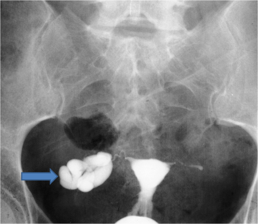 The Afa Blog Checking Tubes The Hsg Is Better Than The Saline Sonogram