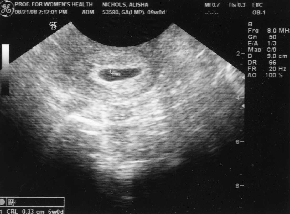 Как выглядит узи на 6 неделе. Снимок УЗИ на 6 неделе беременности. Снимки УЗИ на 6 неделе беременности.