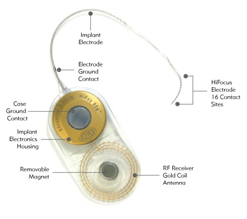 Hearing In Stereo: How Does a Cochlear Implant Work?