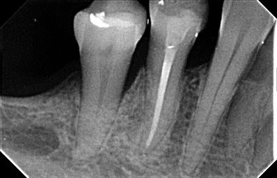 EQUIPE DE ENDODONTIA DE CAMPINAS: RX DIGITAL