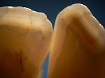 Abrasioni, fratture