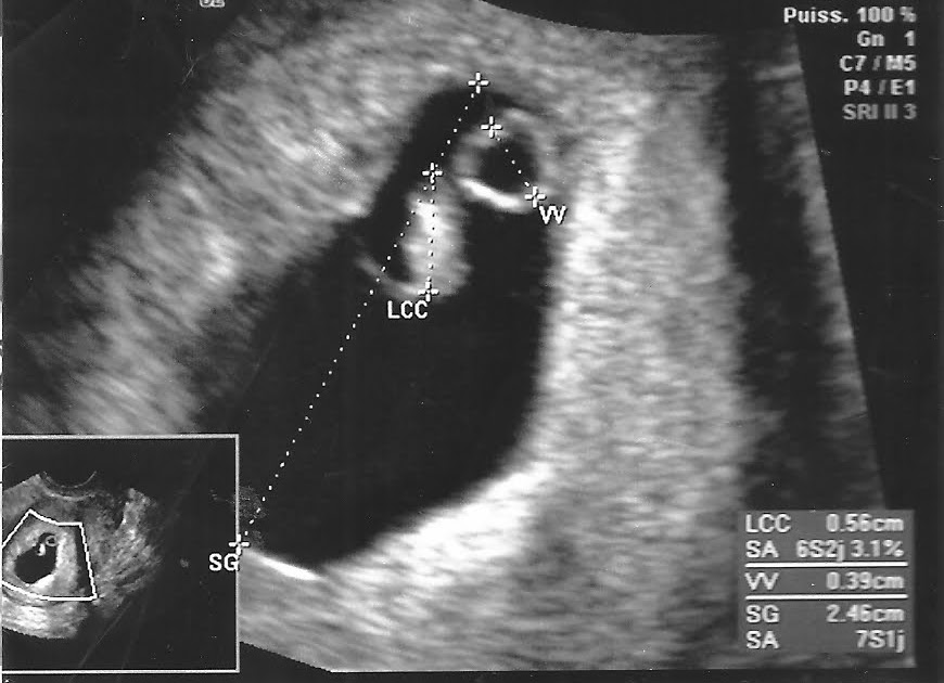 Mini n0us & n0us Echographie 6 semaines (petite crevette)
