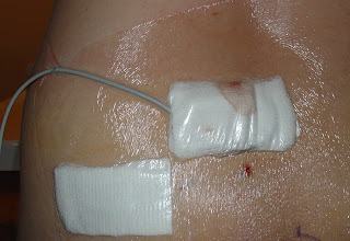 Day 1 after part 1 surgery of InterStim | Random Thoughts, Reviews