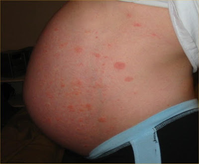 Specific Pregnancy Dermatoses - Medscape