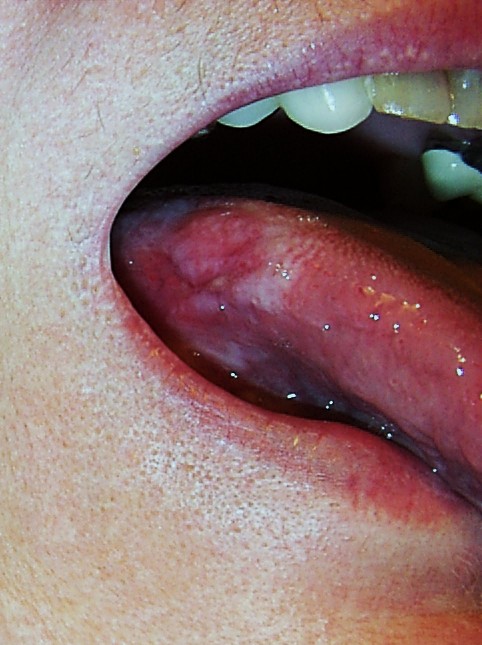 oral lichen planus #10