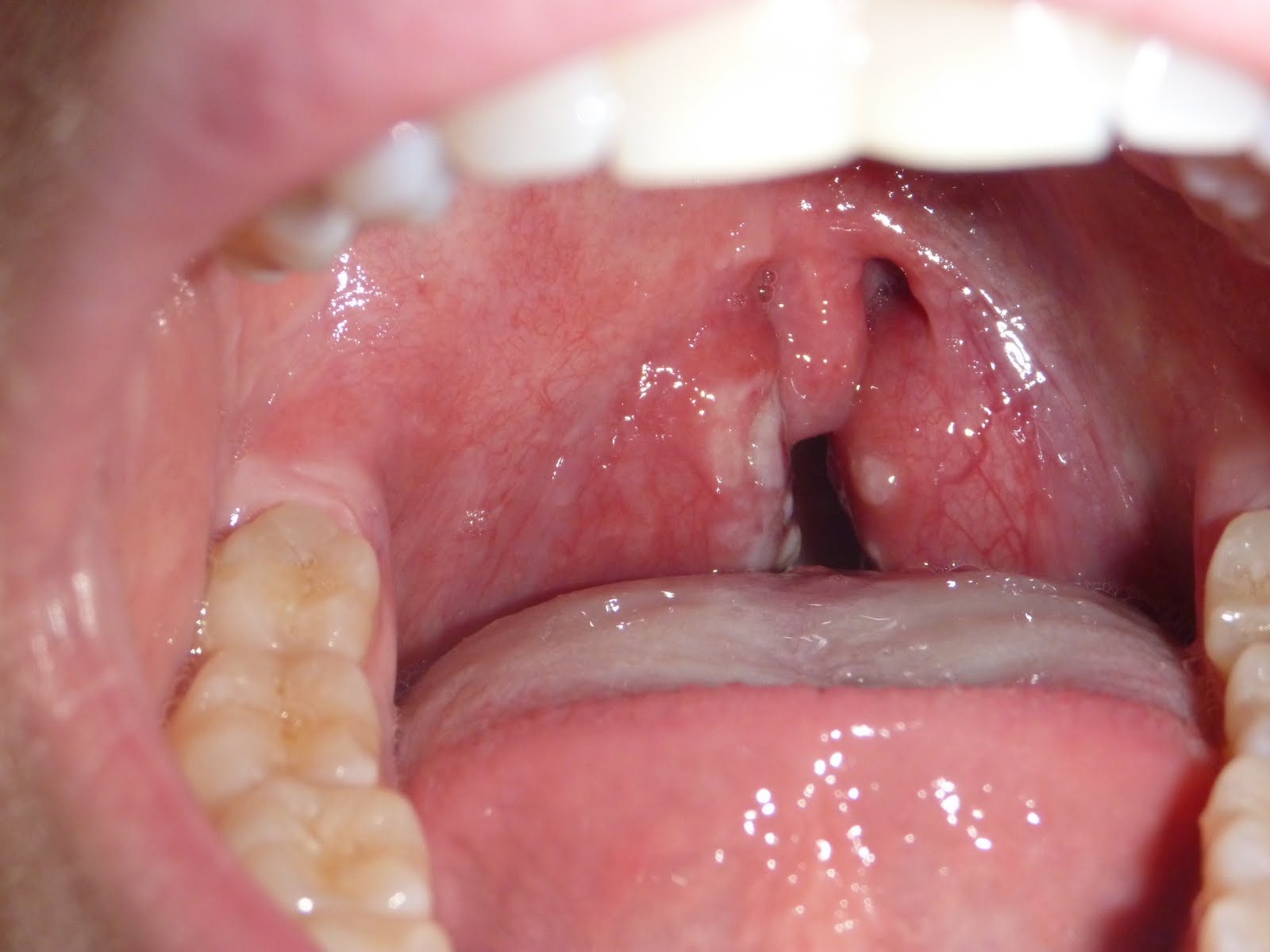 Strep throat in adult without spleen