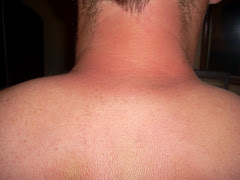 Wear Sun Screen