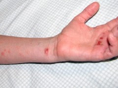 Vitamina d para dermatitis atopica