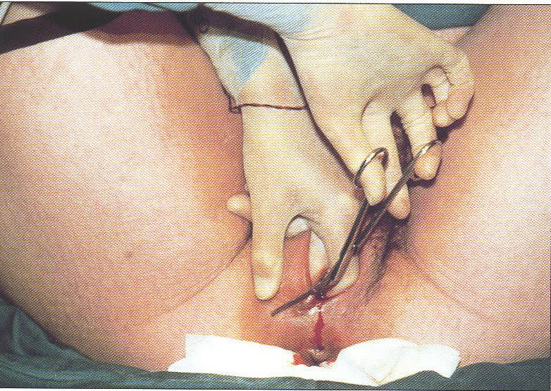 Vaginal Tear (Non-Obstetric) - Fairview Health Services