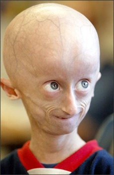 Syndrome  Hutchinson-Gilford (  Progeria )