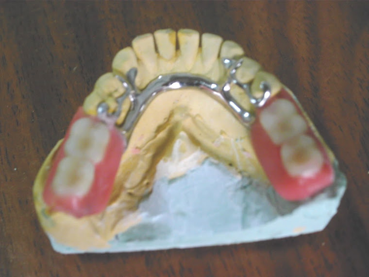 cromo-cobalto-santa-fe-protesis-cromos-para-protesis