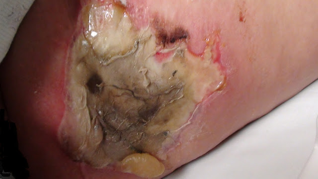 My Burns from Radiofrequency Ablation.