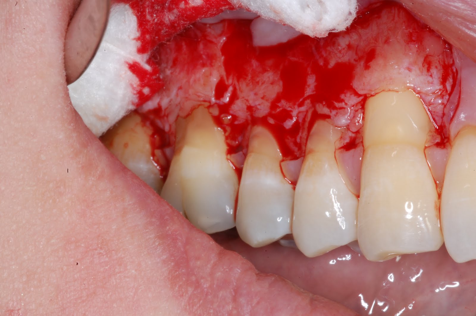 perfect tissue teeth treatment gum disease periodontal smile laser connective why surgery cure much should imazu mel prevent counter mouth