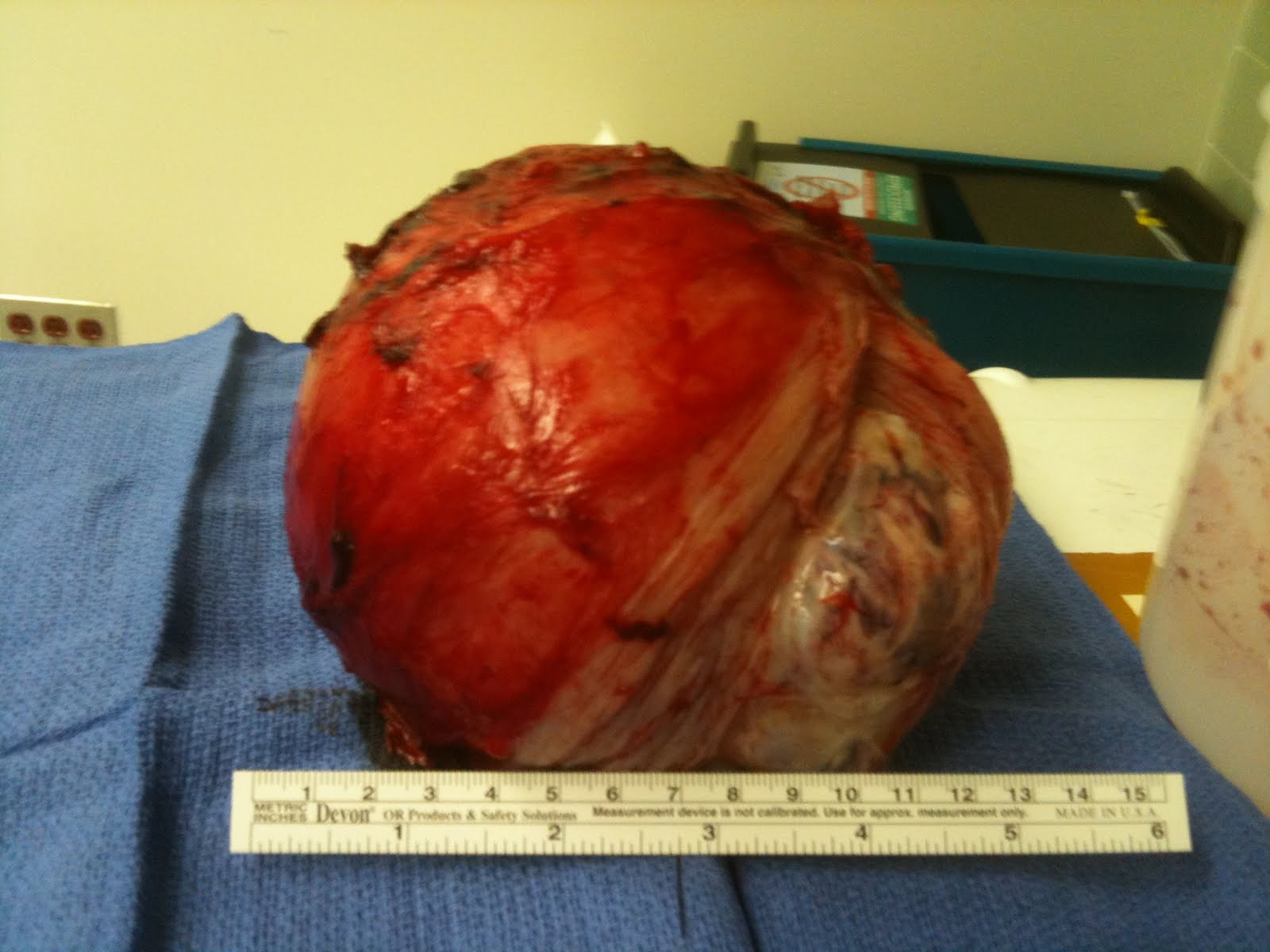 Fibroid Inside and OUT (a bit graphic)