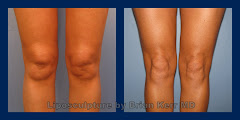 Boise Knee Liposuction