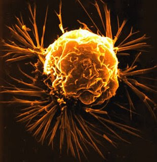 http://3.bp.blogspot.com/_O-jNuGFNKHk/SrMQSLypB4I/AAAAAAAAAoQ/j0FCW5cJpAY/s320/breast+cancer+cell.jpg