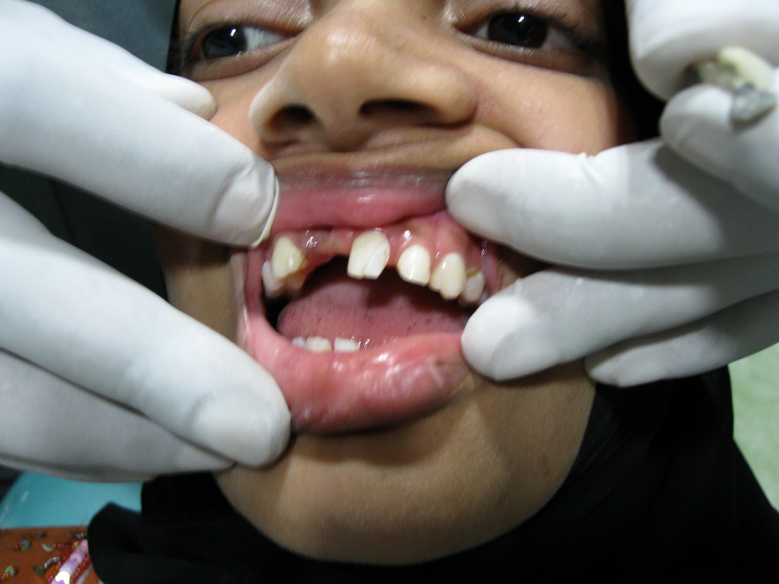 DENTO CARE DENTAL CLINICS MARYLAND BRIDGE