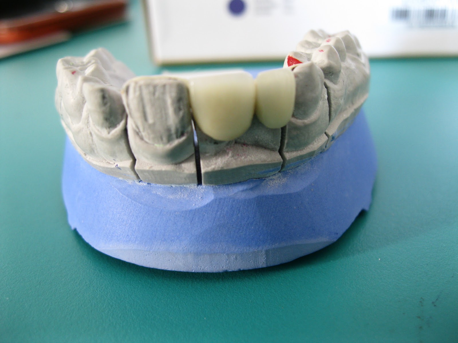 DENTO CARE DENTAL CLINICS MARYLAND BRIDGE