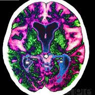 Medicina natural y un cerebro aquejado de Alzheimer