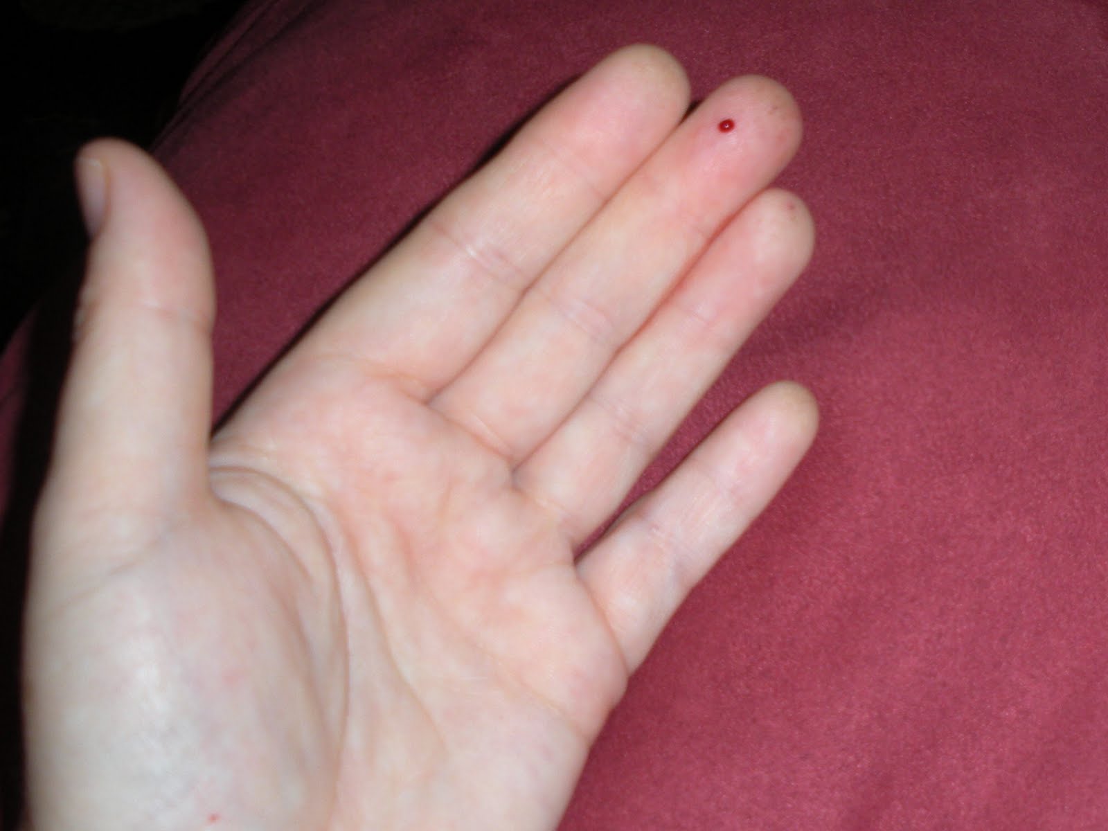 freckle on finger