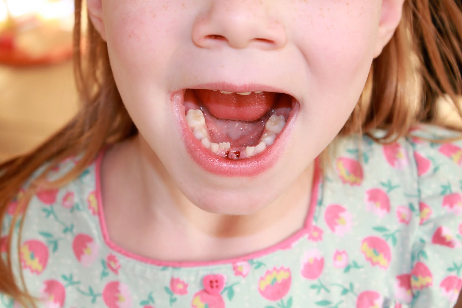 Team Andros Pulling Teeth