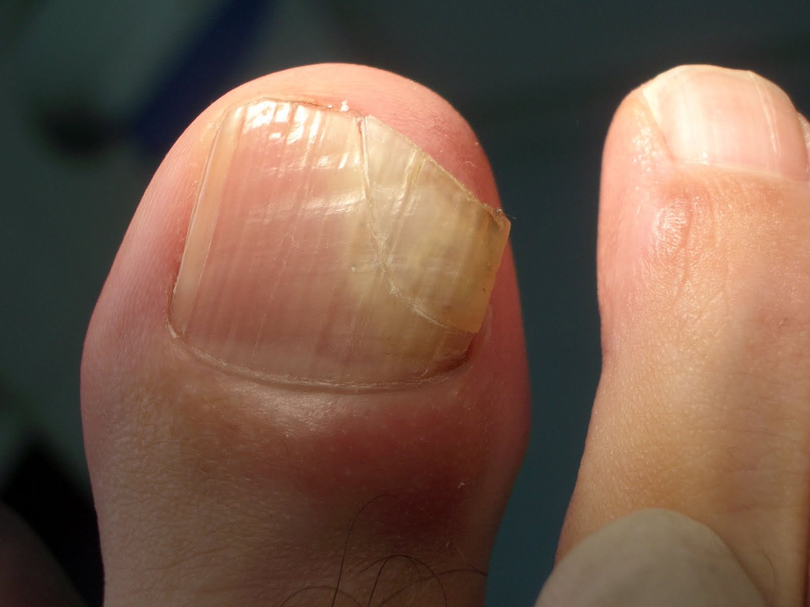 Tumor glómico subungueal