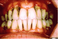piorrea infeccion encia periodontal periodontitis