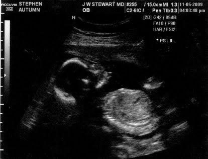 Ultrasound Image of Porter Wendell Stephen