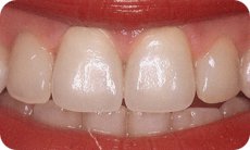 kaplama dislerde diseti renklenmesi