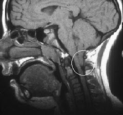 A Chiari MRI