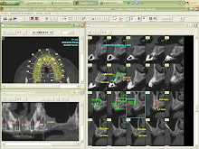 Diagnostico y PLanificacion Tomografica