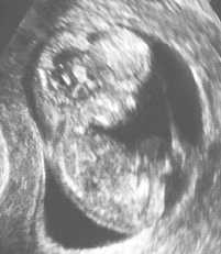 11 week ultrasound