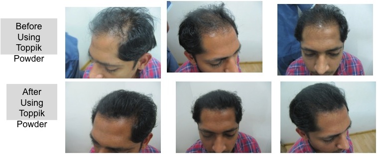 Good Bye Hair Loss Hair Loss Tips Advice Online Dec 3 2010