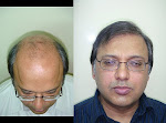 My Hair Transplant in Pakistan