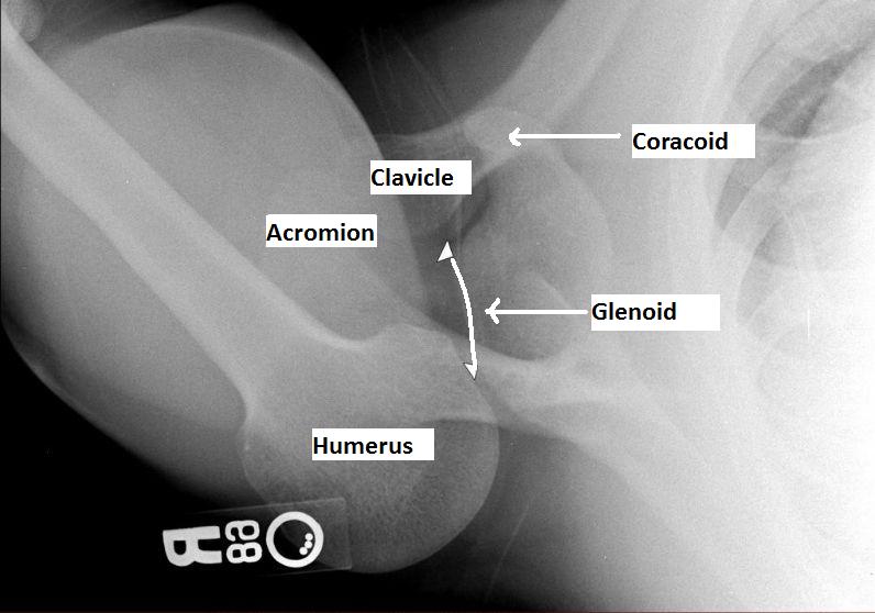 Identify the pathology on this axillary view of the shoulder. little