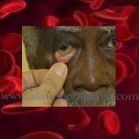 Noções Gerais sobre a anemia, doença que afeta o sangue.