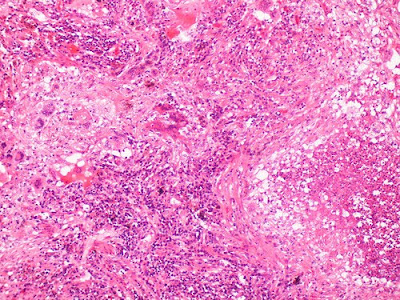 Inflammation (Pathology)  Alchemipedia