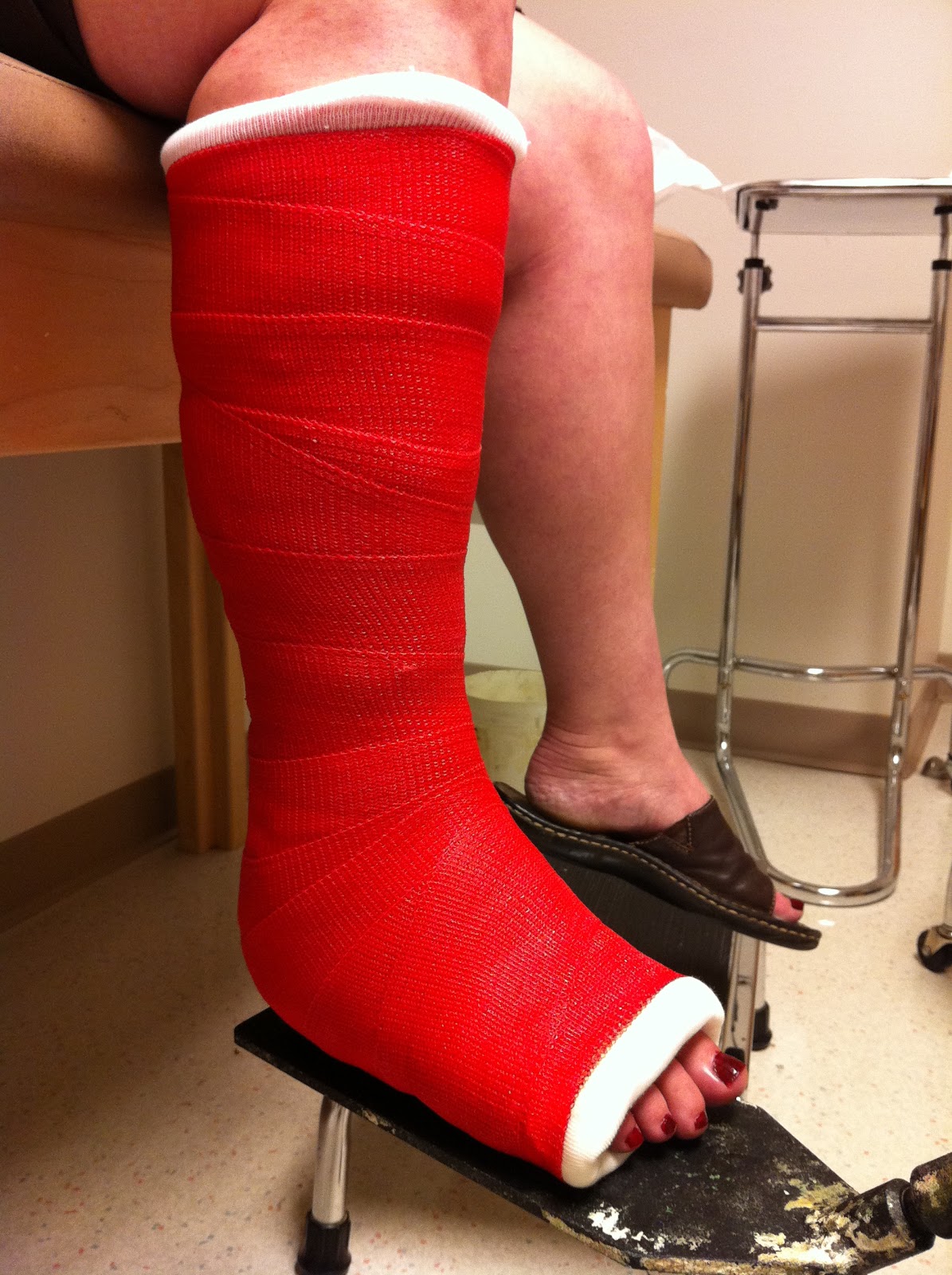 Peroneal Tendon Surgery Experience