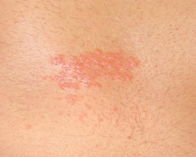 Itchy Rash On Lower Back/Buttocks? - Dermatology - MedHelp